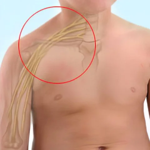 Brakial Pleksus Hasarı