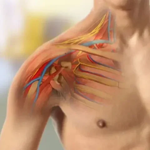 Brakial Pleksus Hasarına Ameliyatsız Tedaviler