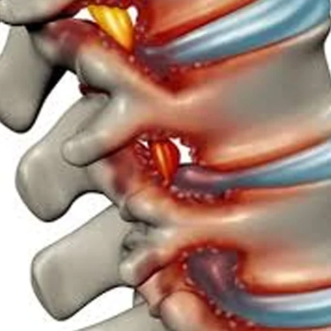 Dar Kanal Hastalığı