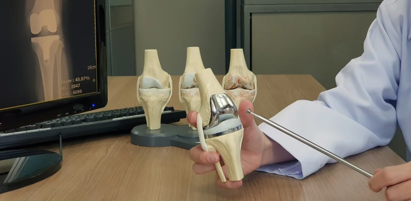 Diz Kireçlenmesi (Osteoartrit) Nedir? Belirtileri ve Evreleri