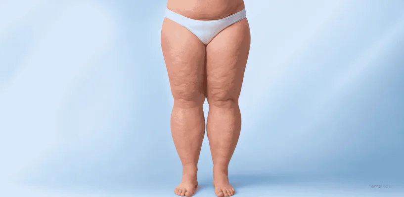 Lipödem (Ağrılı Selülit) Nedir? 